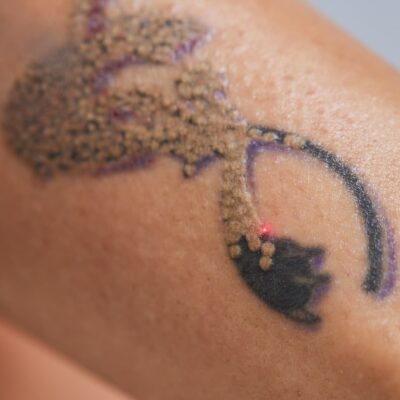 Laser Tattoo Removal in Columbia, SC